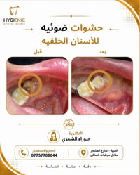 حشوات أسنان • عيادة هايجنك • الحريه