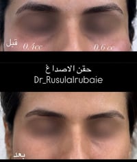 بكجات للعروسات • تنظيف بشرة • حقن ابر نضارة