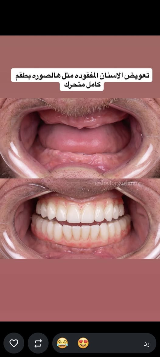 للتواصل واتساب ***********

نص مكتوب في الصور:
- تعلن كلية طب الاسنان في جامعة الهادي عن فتح عياداتها لاستقبال المراجعين لعلاج الحالات التالية:
- 1.حشوات ضوئية
- 2.قلع الاسنان التالفة وبقايا جذور الاسنان
- 3.تنظيف الاسنان وازاله التكلسات
- 4.تعويض الاسنان بتخم كامل متحرك (لكبار السن)
- 5.حشوات الجذور
- 7.عيادات خاصه ووقت خاص لاسنان الاطفال
- العنوان: الدورة/نهاية شارع 60 / مقابل كنيسة بطرس وبولص
- العلاج مجاني للاستفسار التواصل على الخاص
- nyoro.il 7 د تنظيف الاسنان من التكلسات شرط عندكم تكلسات مثل هالصوره ✨ العلاج مجاناً ✨
- اي شخص يعاني من بقايا جذور تالفه ويحتاج قلع يتواصل ويايه علمًا ان العلاج مجاناً
- تعويض الاسنان المفقوده مثل هالصوره بطقم كامل متحرك
- تعويض الاسنان المفقوده بطقم كامل متحرك