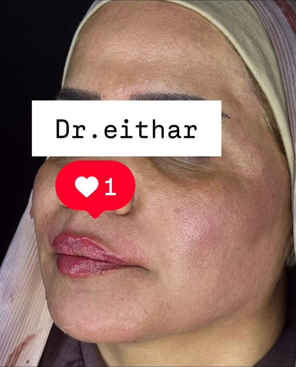 كونتور الوجه بالفلر  (لفتنك وجنات  واصداغ وتدوير الفك والذقن ونظاره وشفة وبوتوكس ) 🔥🔥
لاحضو الفرق بالذقن ومنطقه الفك   شكد تغير الشكل🔥
عروووض للكادر التدريسي والخريجات والموظفات والعروسات  ثبتتهه الكم بالستوري بالهايلايت وببوست اعلى الصفحة ✨✨

د.ايثار سامي عبد الامير
واسط الكوت الهوره مجمع القبطان طابق اول 

الحجز***********

نص مكتوب في الصور:
- Dr.eithar 1