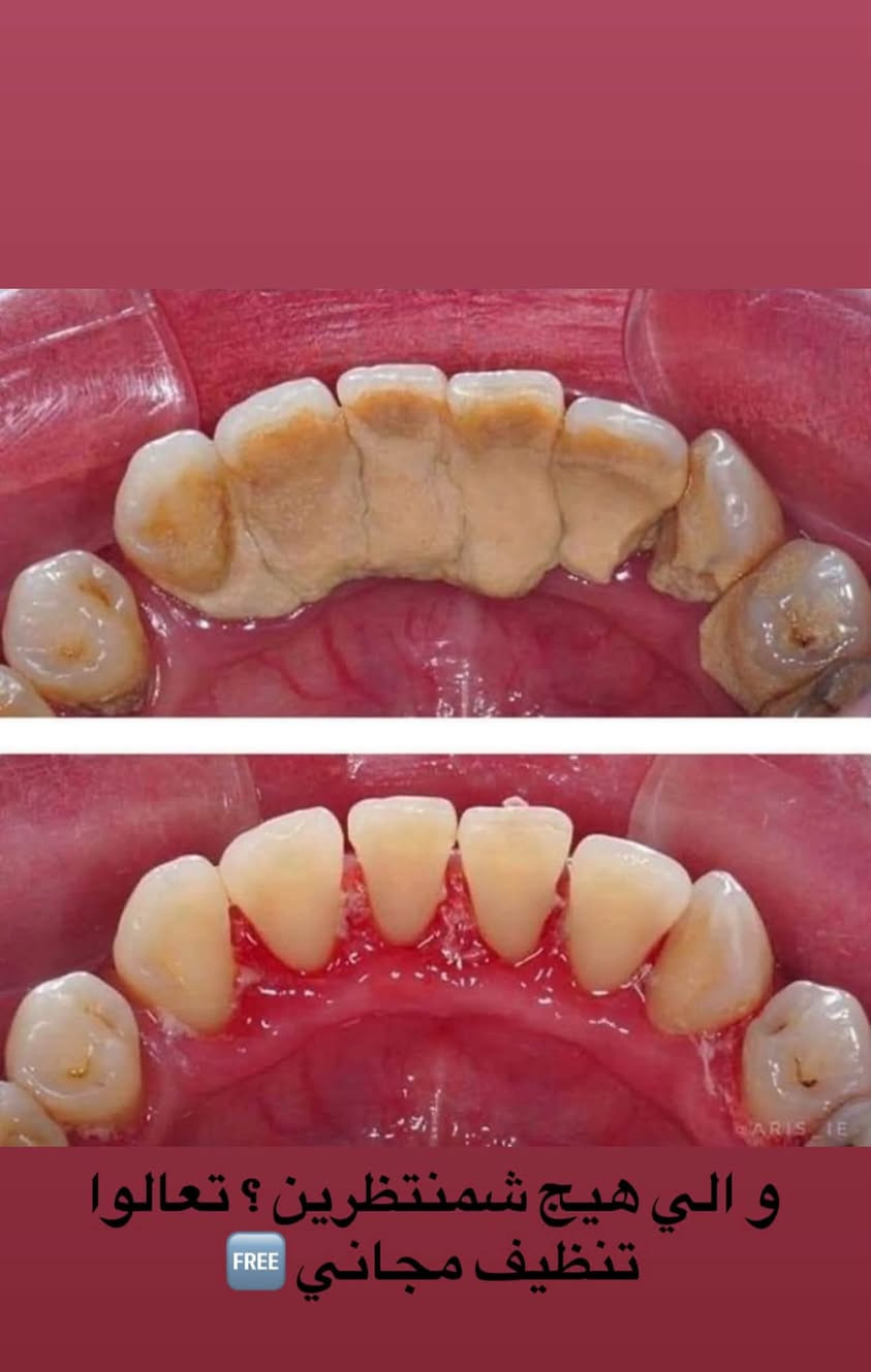 � رجعت العيادات، وراح أرجع أستلم حجوزات!
إذا عندك/ج سن مأجل علاجه من زمان.. يمكن هسه وقته! 🦷🤍

🚨 جبتلكم خبر حلو هم!
صرت أستلم أطفال وأعتني بأسنانهم 👧🏻🧒🏻🦷
إذا يحتاجون علاج للتسوس، ونقدر نسويلهم تطبيق فلورايد لحماية أسنانهم ✨

وكذلك أستلم حشوات جذور للأسنان الأمامية 🦷

📍 العنوان: جامعة التراث – المنصور
☎️:***********
Inst:dr__.manar

الحالات تشمل:
🦷 الحشوات
🦷 حشوات الجذور
🦷 القلع
🦷 تنظيف الأسنان
🦷 تركيب طقم كامل للأسنان المفقودة

🤍 علماً أن العلاج مجاناً وتحت إشراف الأطباء الاختصاص.

وسيتم تنزيل الحالات المطلوبة، فإذا حابين تكون حالتكم من ضمن الحالات، راسلوني حتى يتم تثبيت الموعد 🌷

وأتشرف جداً أكون أنا اللي أتابع حالاتكم 🤍🫶�

نص مكتوب في الصور:
- الي عدهم هيج جذور متبقية راسلوني
- الي عدهم هيج حالات يحتاجون تنظيف
- و الي هيج شمنتظرين ؟ تعالوا تنظيف مجاني FREE
- مثل هيج حالات من الاسنان الاماميه تكون مكسورة او متآكله همين نرجع الابتسامه الحلوه الكم
- لو هيج حالات من التسوس يكون قريب من اللثه
