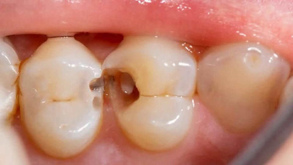 تسوس • علاج مجاني • جامعه المستقبل