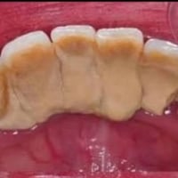 تنظيف اسنان • مجاني • تكلسات قوية