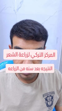 مركز زراعة شعر • كادر تركي • نتيجة بعد سنة