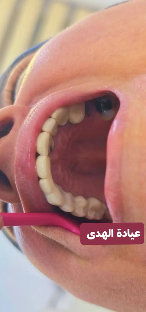 عيادة الهدى لطب الأسنان والتجميل

تقاطع الجدوع مجاور عالم الحليب

***********

اهلا وسهلا بزبائنا الاعزاء

متواجدين يوميا من ٤ عصرا إلى ٩ مساء

نص مكتوب في الصور:
- عيادة الهدى
- BEFORE | قبل AFTER | بعد عيادة الهدى
- BEFORE | قبل
- AFTER | بعد