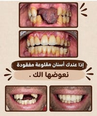علاج مجاني • عيادات جامعة واسط • تعويض أسنان