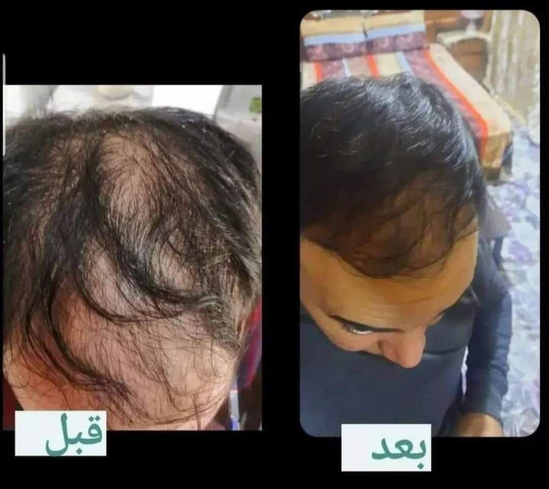 السلام عليكم :
الكتابة
✨ عناية لبشرتك… لأنك تستحق الأفضل ✨
نوفر لكم مجموعة مميزة من منتجات العناية بالبشرة للرجال والنساء 🧴💆‍♀️💆‍♂️
🇮🇷 منتجات إيرانية من شركة لدورة 🌿
💗 منتجات للنساء والرجال
💗 استشارة مجانية لاختيار المنتج المناسب
💗 متابعة الزبون كل أسبوع
💗 متابعة مستمرة وإرشادات لطريقة الاستخدام
📲 متواجدين على الواتساب للاستفسار والطلب:
***********
***********
✨ تواصلوا ويانا، والاستشارة مجانية ✨

نص مكتوب في الصور:
- بعد استعمال بكج التساقط من ماركة لدورا
- قبل بعد
- بشره تعاني من الكلف وحساسيه بالدم بعد استخدام منظف شيرباكون+مصل الكافيار لمدة ١٠ ايام
- بعد استخدام ١٠ ايام من المنتجات
- بعد
- قبل
- بعد استخدام عصاره الليكس
