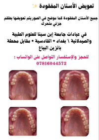 تعويض الأسنان • طقم جزئي متحرك • عيادات ابن سينا