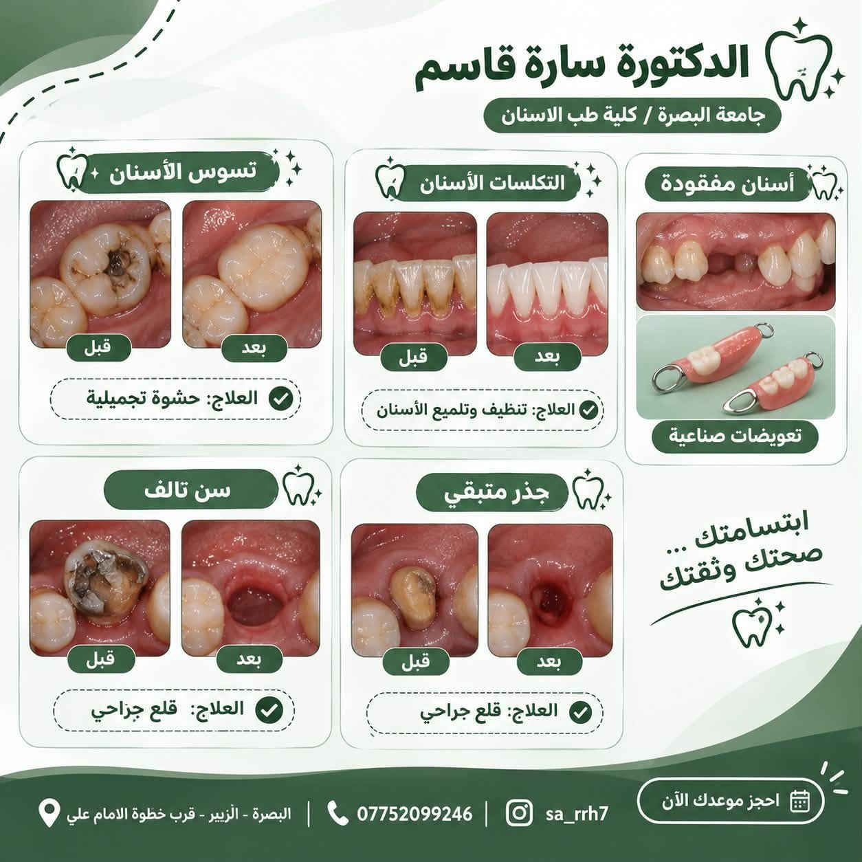 علاج أسنان مجاني • حشوات ضوئية • البصرة - الزبير
