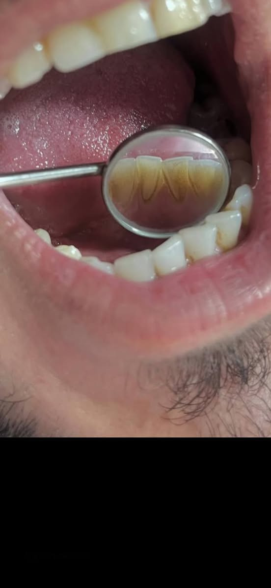 السلام عليكم ، يتوفر علاج مجاني باشراف دكاترة مختصين ، للتواصل والاستفسار...
***********

نص مكتوب في الصور:
- الدكتورة تبارك باهض الدليمي حشوات ضوئية تنظيف اسنان قلع الاسنان وبقايا الجذور تعويض الاسنان المفقودة بطقم جزئي متحرك *********** بغداد - حي القاهرة علماً ان العلاج مجاني وبإشراف اطباء اختصاص