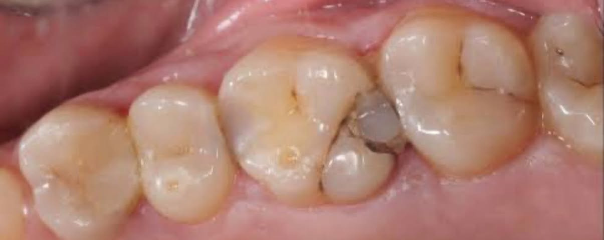 مساء الخير جميعاً..🤍
نستقبلكم في عيادات مستشفى جامعة المشرق لطب الاسنان لتقديم الخدمات العلاجية 

أي شخص يعاني من المشاكل التالية ممكن يزورنا لمستشفى جامعة المشرق الخاص بطب الأسنان ويتلقى العلاج  بعيادات عالية المستوى وبضروف تعقيم مشددة 

#الحالات_الي_نعالجعها : 

▫️ تنظيف الأسنان من التكلسات 
 
▫️ قلع الاسنان التالفة او الجذور المتبقية ( اذا كان السن في حالة سيئة ويحتاج إلى القلع ) 

▫️ حشوات الأسنان  ( حشوات تجميلية للأسنان الأمامية وحشوات للأسنان خلفية ) 

▫️ تعويض الأسنان ( عمل طقم  للأسنان المفقودة لمن يعاني من فقدان الأسنان الجزئي او الفقدان الكامل بسبب تقدم العمر او بسبب بعض الأمراض ) 

⭕️ العلاج بسعر #مجاني 
⭕️ العلاج بإشراف كامل من أطباء مختصين 

أي شخص يعاني من اي من المشاكل اللي ذكرتها يكدر يراسلني على الواتساب ويحجز موعد على رقمي :  ***********
أو مراسلتي على الفيسبوك
