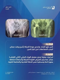 كسر عنق الفخذ • تبديل ورك ثنائي القطب • الديوانية