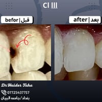 Made filling composite for upper left lateral incisor 🎖️ عمل حشوه تجمي...