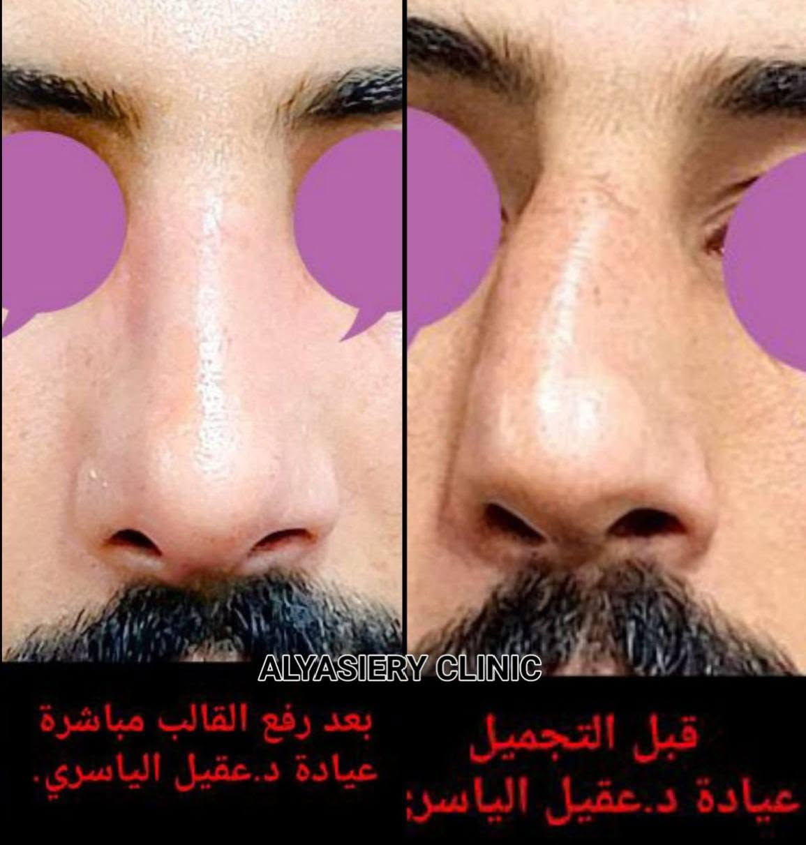تجميل أنف • قبل وبعد • عيادة الياسري