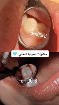 الي محتاج قلع حشوات تنظيف للاسنان وبشكل مجاني العنوان//اليرموك-الاربع ...
