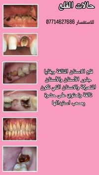 قلع أسنان مجاني 🦷✨ 📢 فرصة للعناية بابتسامتك مجاناً! يتوفر قلع الأسنان ...