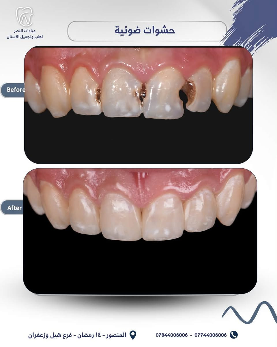 ⁨ ⁨ حشوات تجميلية بلون الأسنان، تعالج التسوس وتحافظ على شكل الابتسامة الطبيعي ✨

لأن التفاصيل الصغيرة تصنع فرق كبير⁩

احجز موعدك الآن! 🦷✨

***********
 ***********
‎📍 العنوان:
‎  المنصور - 14 رمضان - فرع هيل وزعفران

#حشوات #يوميات  #اسنان  #اكسبلورexplore⁩⁩⁩⁩⁩⁩
