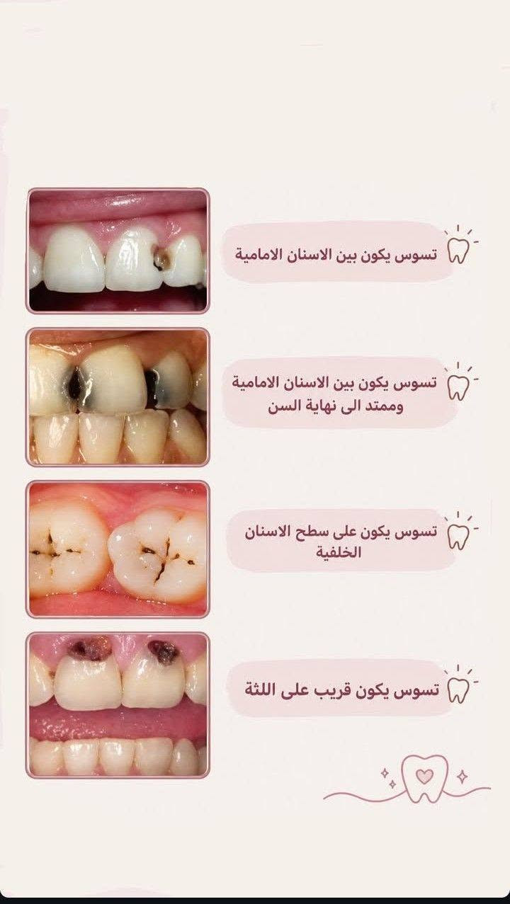علاج مجاني • عيادات جامعة واسط • تعويض أسنان