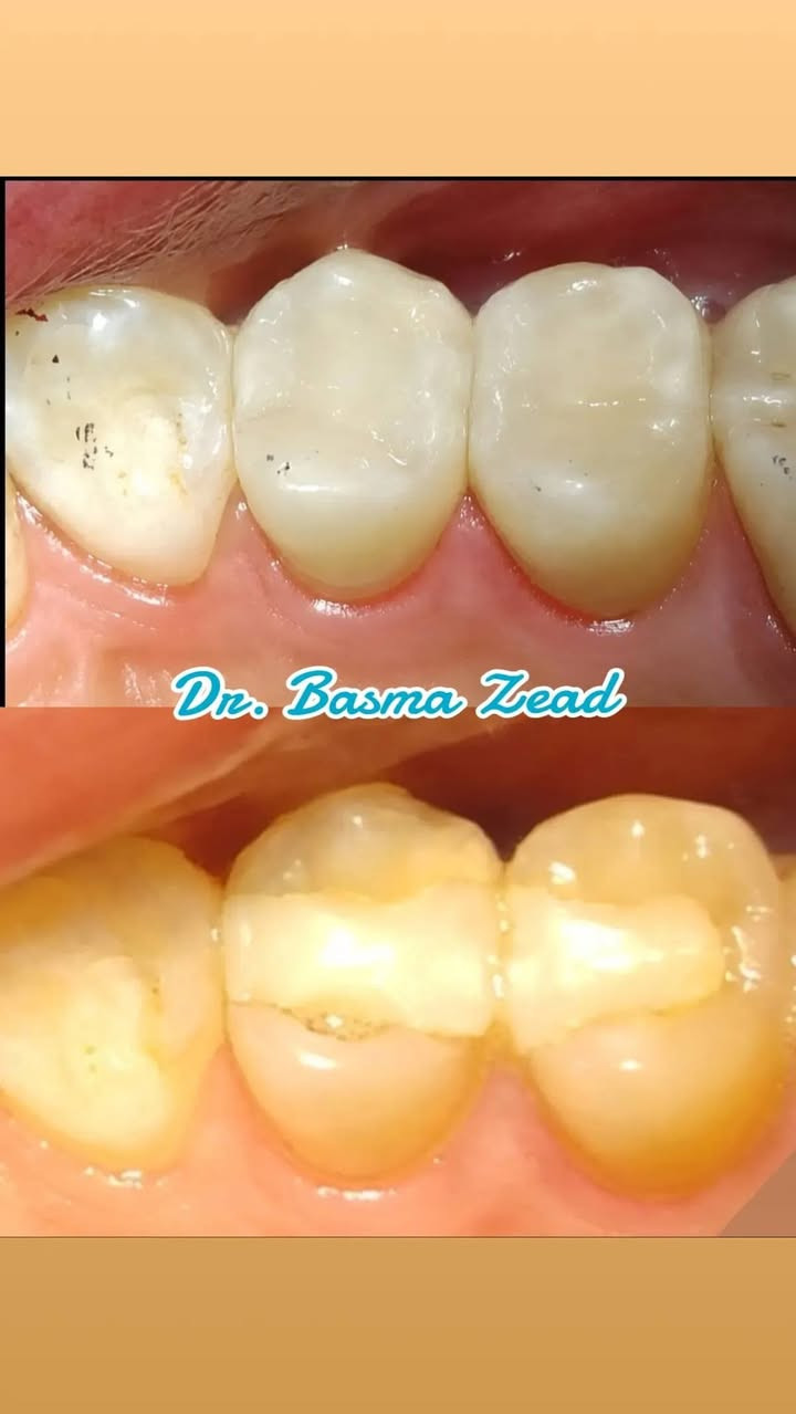 سلام عليكم ورحمة الله وبركاته
✨ فرصة مميزة لعلاج أسنانك بأسعار رمزية 🦷
طبيبة أسنان حاصلة على عدة شهادات ودورات تدريبية في مجال طب الأسنان، تقدم خدمات علاجية لمختلف الحالات بأسعار رمزية تصل إلى نصف السعر.
🔹 يشمل استقبال مختلف الحالات السنية
🔹 أسعار مناسبة ومخفضة
🔹 يتم توثيق ودراسة كل حالة ضمن بحث علمي بهدف تطوير الخبرة والجانب العلمي والسريري.
🔷 بيئه آمنه ومعقمه لكل مراجع ادوات خاصه به يتم التخلص منها بعد انتهاء الجلسه. 
📍 للحجز والاستفسار:
📱 واتساب: ***********

العلاج بامانه تامه ويوجد كارت ضمان مع تقرير كامل لحالة كل مريض وتتوفر صور لحالات علاجية من شغلنا على صفحتي الخاصه 📸
