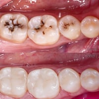 حشوة تجميلية • خلع أسنان • جامعة التراث