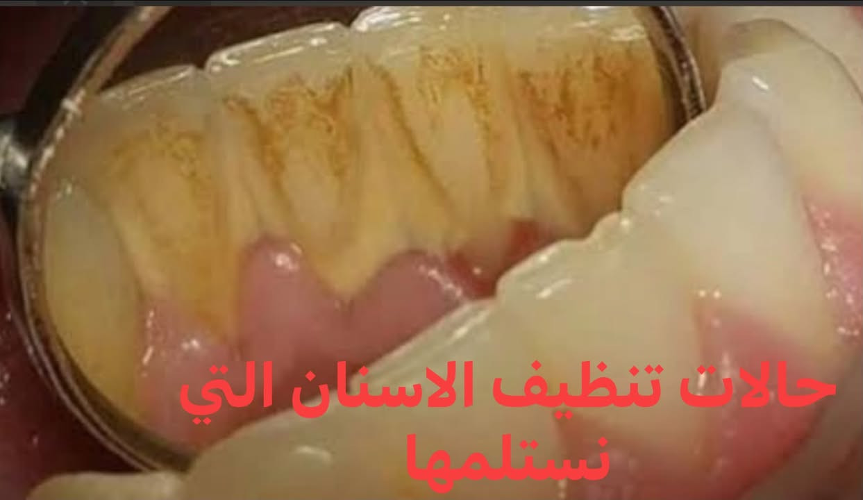 علاج مجاني • قلع أسنان • حشوة ضوئية