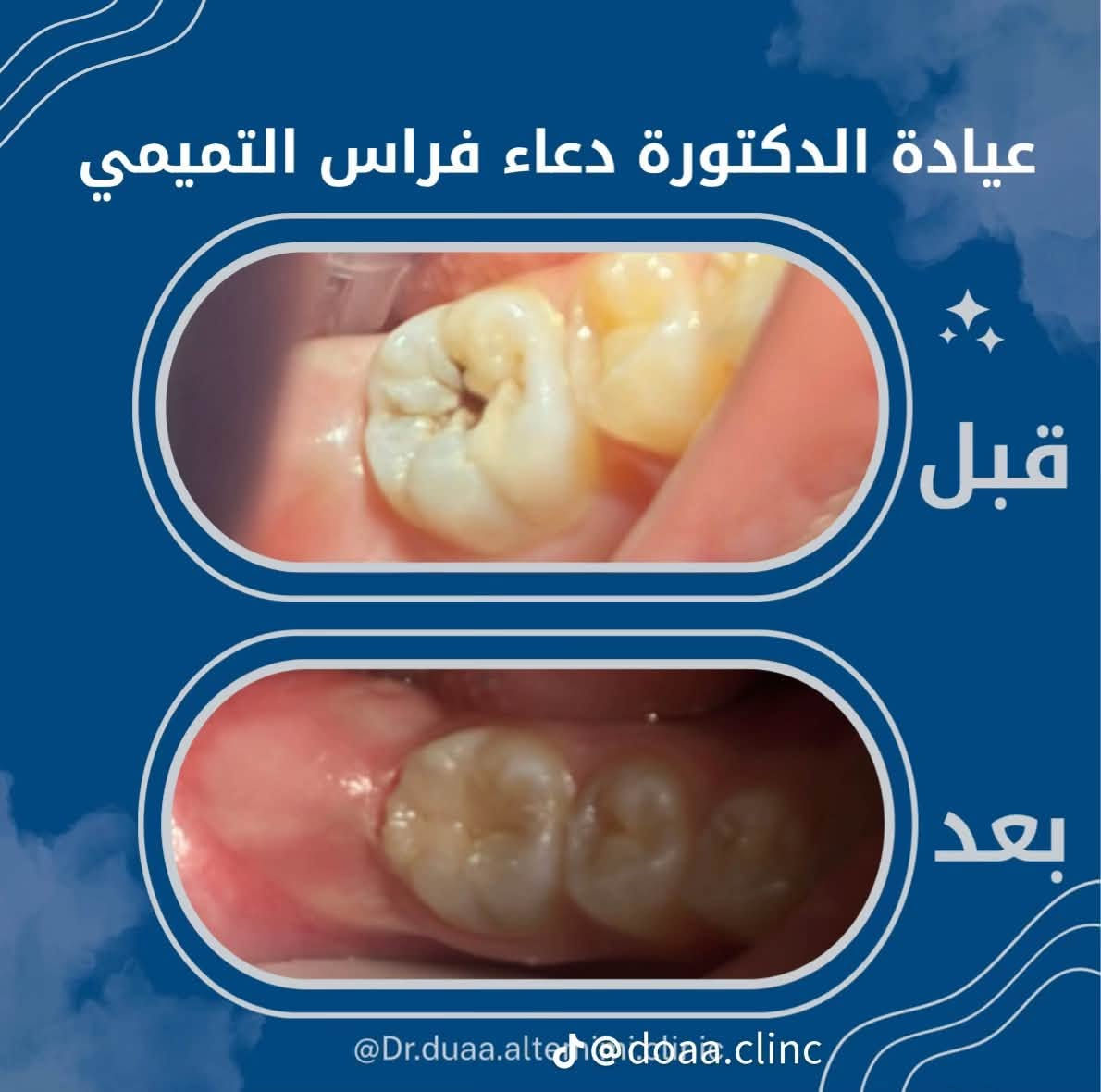 🦷عيادة الدكتورة دعاء فراس التميمي 🦷
-لعلاج الاسنان بالتقويم الشفاف والمعدني 

-زراعة الاسنان وعمل التراكيب السنية بالزاركون والسيراميك 

-عمل الحشوات التجميلية وحشوات الجذور 

-تنظيف وتبيض الاسنان بالليزر 

📍الكمالية - شارع الجامع  - مقابيل مثلجات الفريداوي 

🕠اوقات الدوام من الساعة 

4  مساءً الى الساعة  2 بعد منتصف الليل 

جميع ايام الاسبوع 

📞للحجز والاستفسار :

***********
