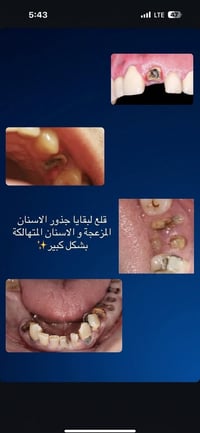 قلع جذور • مجاناً • كلية المستقبل