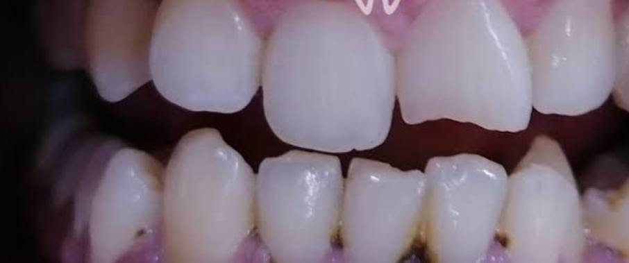 🦷 حشوات أسنان مجانية 🤍

أي شخص محتاج حشوة أسنان مجاناً، باچر متوفر علاج الساعة 12 ظهراً.

📍 الجمعية – خلف مول الحارث

 التواصل على الخاص أو على الرقم:
📞 ***********
