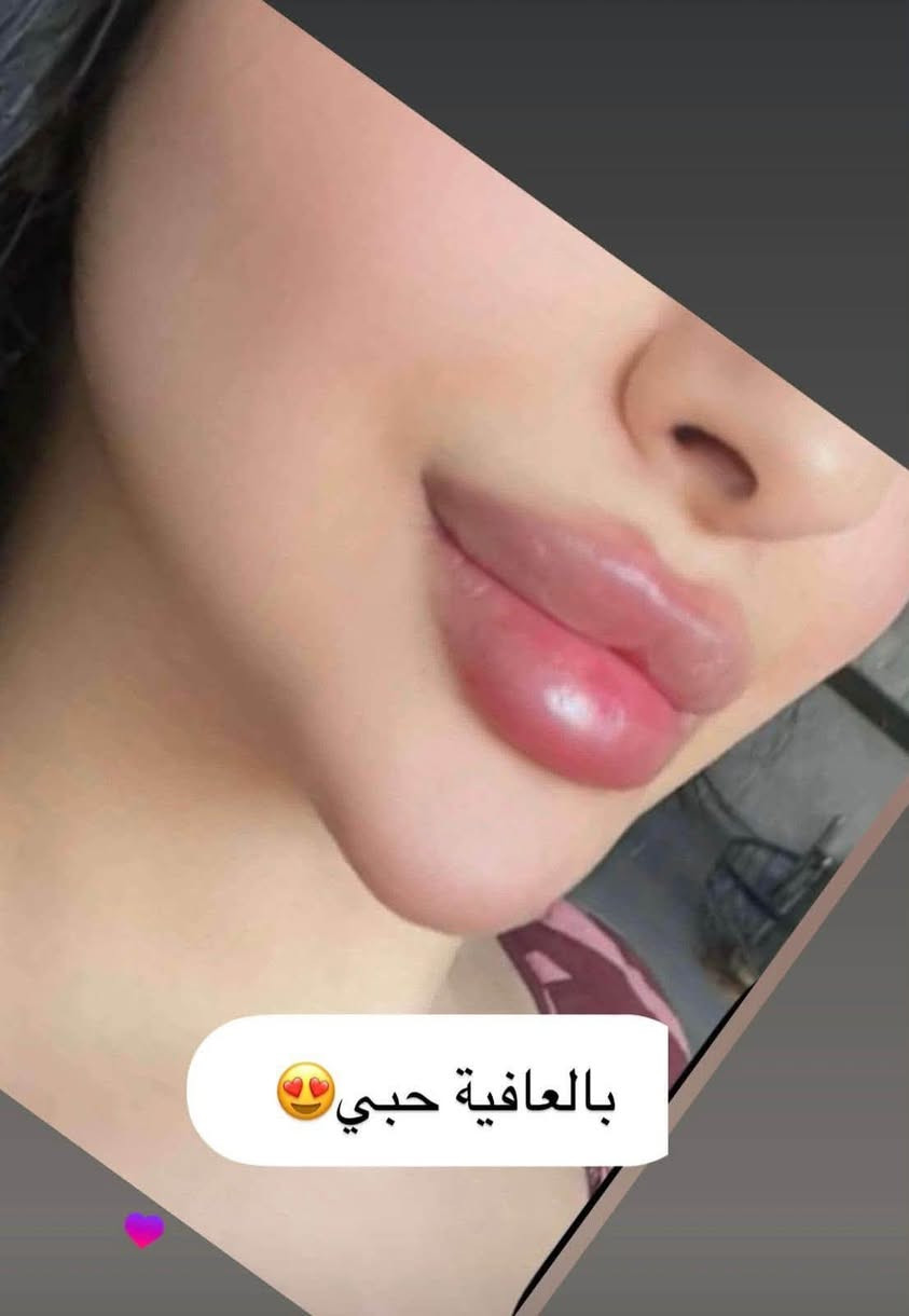 عرض لمده يومين فقط 
فلر فرنسي ب80 الف 
احجزي هسه لان من تنتهي الكميه ينتهي العرض. 
*********** واتساب
