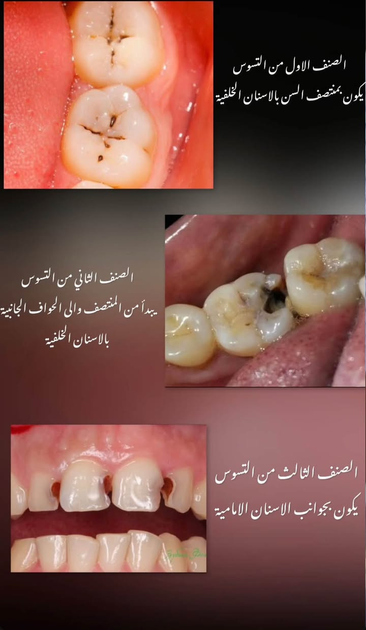 السلام عليكم نستقبلكم لعلاج الحالات الاتية علماً ان العلاج يتم بشكل مجاني تحت اشراف افضل الاطباء وذوي خبرة على مستوى المحافظة اي شخص عنده سن حاب يقلعه او جذور او يريد يسوي حشوة او تنضيف يتواصل مع الرقم ويتدلل العنوان واسط جامعة الكوت (الي صايرة على طريقة الحي) والي يحب يشوف الشغل يدخل على الصفحه علمود يشوف الحالات الي اشتغلنا باعلى كفاءة ولله الحمد

***********

نص مكتوب في الصور:
- اسنان تالفة وجذور متبقية
- الصنف الرابع من التسوس يكون في حواف الاسنان الامامية "تسوس او كسر" الصنف الخامس من التسوس يكون في المنطقة القريبة من اللثة في الاسنان الامامية والخلفية
- تراكم تكلس الاسنان "الجير" مثل هالحالات