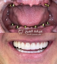 زراعة الأسنان • عيادة الفرح • حي النصر