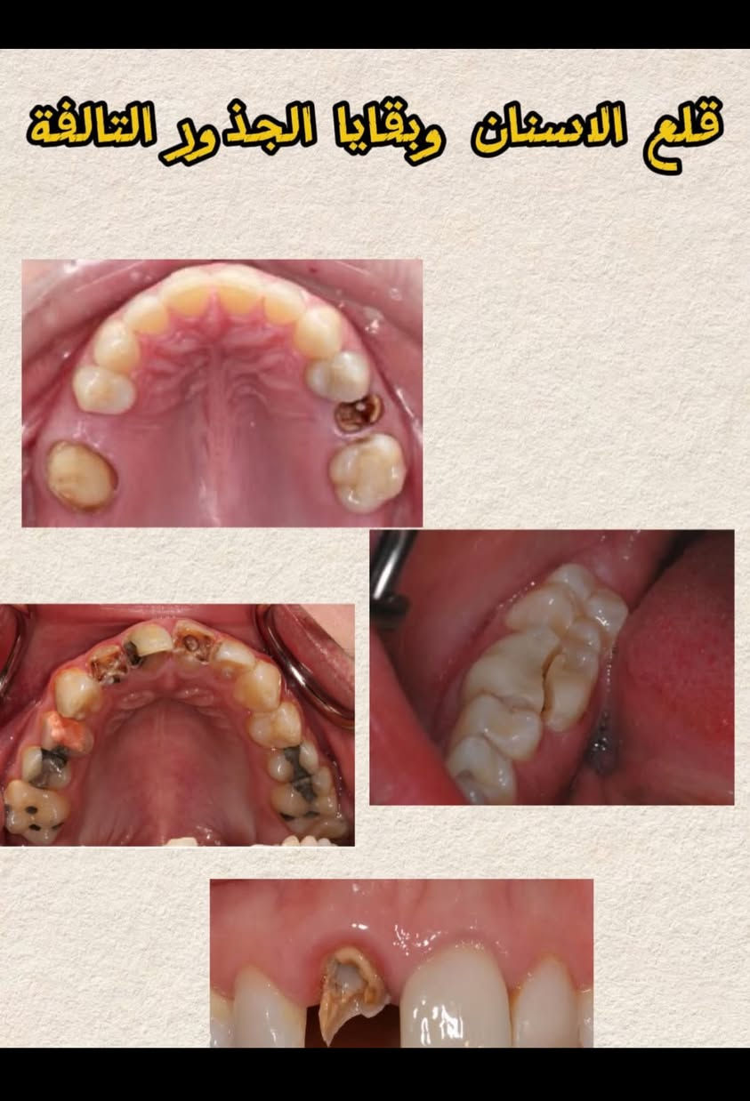 السلام عليكم الي محتاج قلع اسنان او تنظيف او حشوات ضوئية او تركيب طقم متحرك راح يكون العلاج بشكل مجاني وتحت اشراف اطباء اختصاص في محافظة البصرة في عيادات الكنوز التعليمية في الجبيلة للتواصل :
حساب الانستكرام Zainab.razzaqi 
للتواصل واتساب : ***********

نص مكتوب في الصور:
- تنظيف الاسنان وازالة التكلسات
- معالجة التسوس بحشوات دائمة BEFORE AFTER
- تعويض الاسنان المفقودة باطقم جزئية متحركة
- قلع الاسنان وبقايا الجذور التالفة