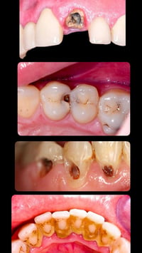 علاج مجاني • حشوات ضوئية • علاج اسنان اطفال