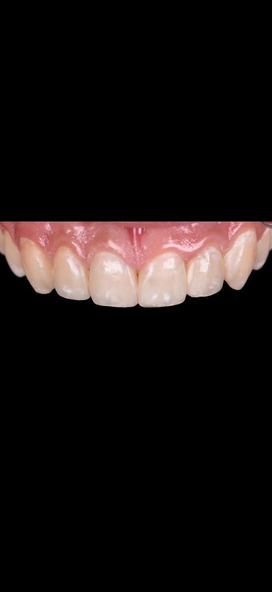 ⁨ ⁨ حشوات تجميلية بلون الأسنان، تعالج التسوس وتحافظ على شكل الابتسامة الطبيعي ✨

لأن التفاصيل الصغيرة تصنع فرق كبير⁩

احجز موعدك الآن! 🦷✨

***********
 ***********
‎📍 العنوان:
‎  المنصور - 14 رمضان - فرع هيل وزعفران

#حشوات #يوميات  #اسنان  #اكسبلورexplore⁩⁩⁩⁩⁩⁩
