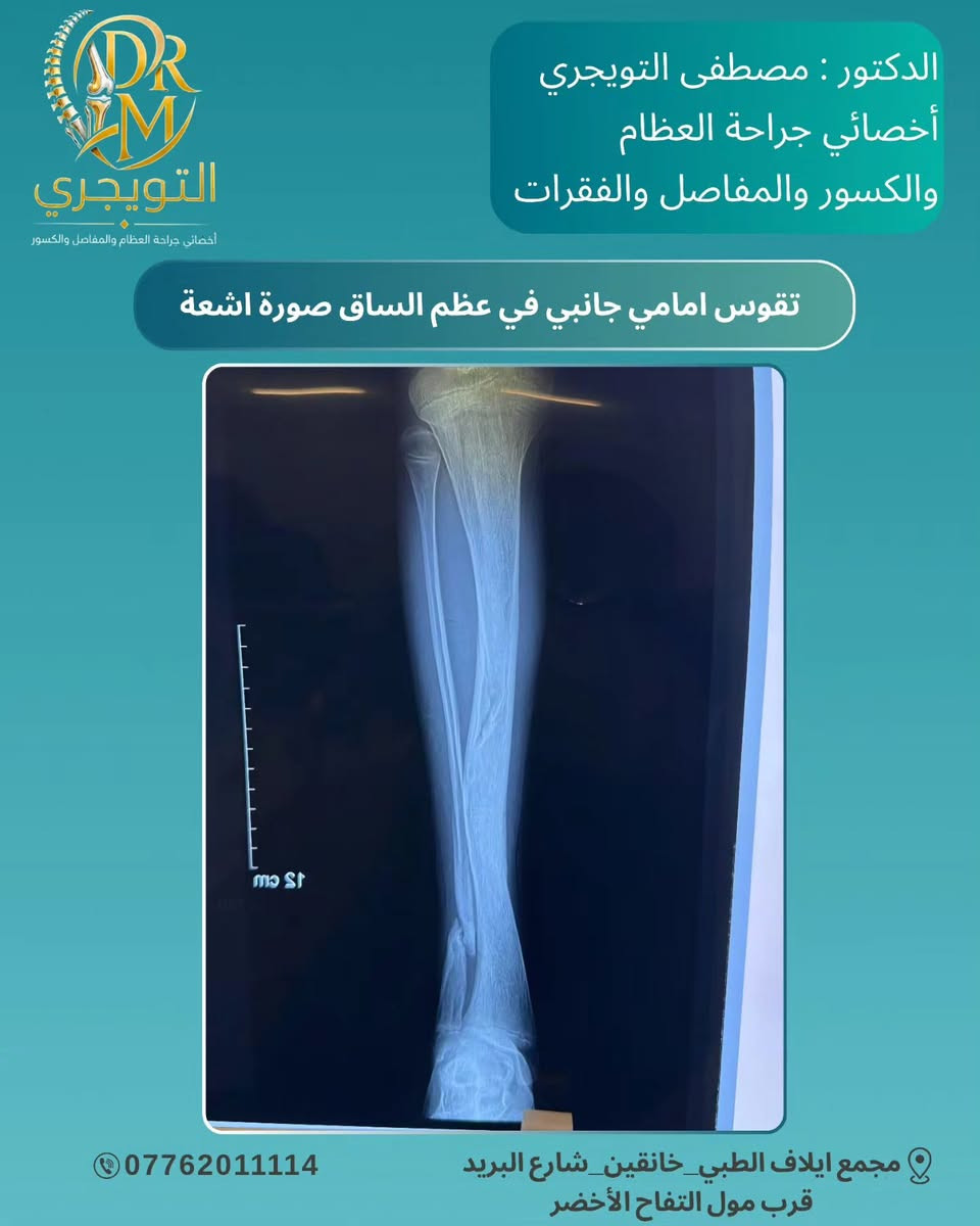 🧬✨ مو كل علامة على الجلد تكون بسيطة… 

الورم الليفي العصبي من النوع الأول (Neurofibromatosis ) هو مرض وراثي يمكن أن يؤثر بشكل رئيسي على الجلد الأعصاب العظام والعينين 🧠🦴👁️ 

التشخيص المبكر والمتابعة الطبية يساعدان على اكتشاف التغيرات ومتابعتها بشكل أفضل ❤️‍🩹 

🔎 الوعي بالمرض… أول خطوة نحو رعاية أفضل.
الدكتور : مصطفى التويجري
أخصائي جراحة العظام والكسور والمفاصل 👨‍⚕️ 

📞 للحجز والاستفسار تواصل معنا الآن
📞 *********** 

📍 العنوان: مجمع إيلاف الطبي _ ديالى خانقين _ شارع البريد _ قرب مول التفاح الأخضر 

✨ رعايتك تبدأ بخطوة… وخطوتك الأولى هي الاستشارة الصحيحة. 

#الدكتور_مصطفى_التويجري
#مجمع_إيلاف_الطبي #خانقين
#الورم_الليفي_العصبي 
#Neurofibromatosis
