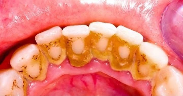 🛑تنظيف أسنان مجااانييييي💯🛑
الي عندة مثل هالتكلسات يتواصل ويانا 
***********

نص مكتوب في الصور:
- Before After
