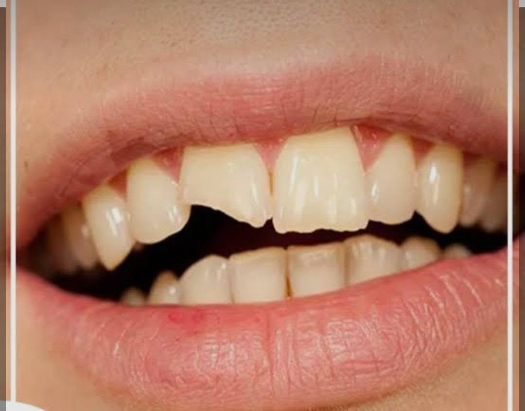 سن مكسور • ترميم سن • جامعة ابن سينا
