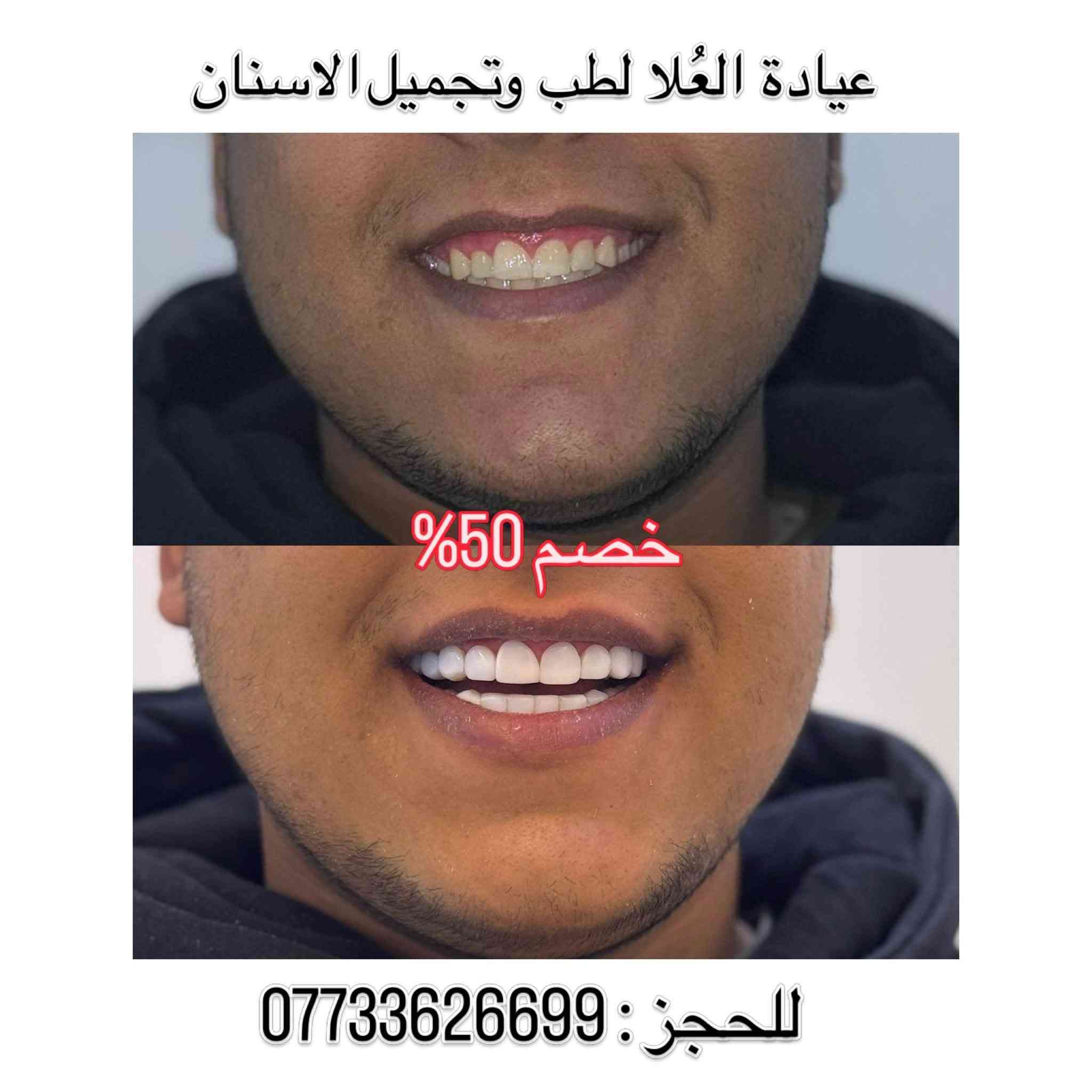 خصم ٥٠٪ • ابتسامة هوليوود • الشرطة الخامسة
