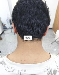 ليزر الرقبة • قبل وبعد • ناحية القيارة