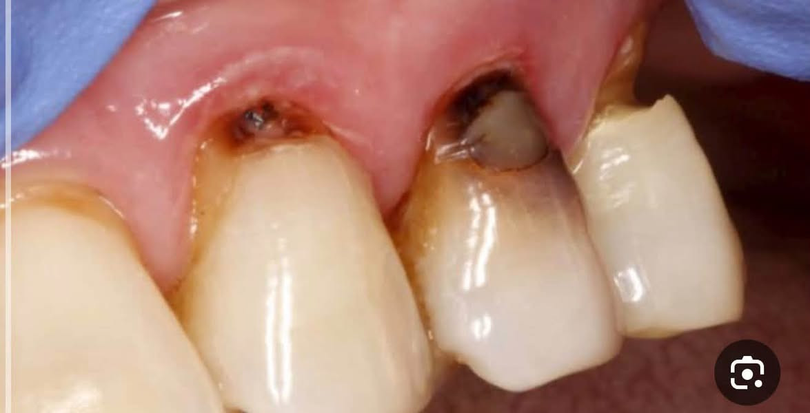 مساء الخير جميعاً..🤍
نستقبلكم في عيادات مستشفى جامعة المشرق لطب الاسنان لتقديم الخدمات العلاجية 

أي شخص يعاني من المشاكل التالية ممكن يزورنا لمستشفى جامعة المشرق الخاص بطب الأسنان ويتلقى العلاج  بعيادات عالية المستوى وبضروف تعقيم مشددة 

#الحالات_الي_نعالجعها : 

▫️ تنظيف الأسنان من التكلسات 
 
▫️ قلع الاسنان التالفة او الجذور المتبقية ( اذا كان السن في حالة سيئة ويحتاج إلى القلع ) 

▫️ حشوات الأسنان  ( حشوات تجميلية للأسنان الأمامية وحشوات للأسنان خلفية ) 

▫️ تعويض الأسنان ( عمل طقم  للأسنان المفقودة لمن يعاني من فقدان الأسنان الجزئي او الفقدان الكامل بسبب تقدم العمر او بسبب بعض الأمراض ) 

⭕️ العلاج بسعر #مجاني 
⭕️ العلاج بإشراف كامل من أطباء مختصين 

أي شخص يعاني من اي من المشاكل اللي ذكرتها يكدر يراسلني على الواتساب ويحجز موعد على رقمي :  ***********
أو مراسلتي على الفيسبوك
