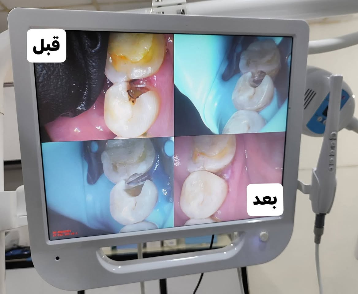 يتواجد الدكتور حبيب فهد الرملي ✨
في عيادة الأسنان –  اسديرة وسطى مجمع سامي الطبي 🦷
لتقديم خدمات طب وتجميل الأسنان بأعلى مستوى من الدقة والاهتمام:
🦷 علاج وسحب العصب
✨ الحشوات التجميلية
🦷 قلع الأسنان والجذور
✨ تنظيف وتبييض الأسنان بالليزر
🦷 تركيبات الأسنان
✨ تيجان الزركون و E-Max
🦷 تجميل الأسنان وصناعة الابتسامة
✨ فحص وتشخيص شامل ومعالجة آلام الأسنان
الدكتور حبيب فهد الرملي
🤍 لأن ابتسامتك تستحق عناية تليق بها.
📍 عيادة الأسنان – مجمع سامي الطبي
📞 للحجز والاستفسار: ***********
