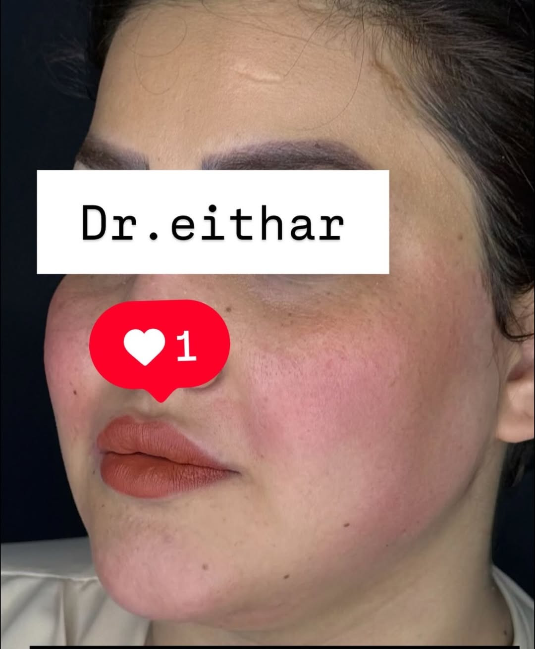 كونتور الوجه بالفلر  (لفتنك وجنات  واصداغ وتدوير الفك والذقن ونظاره وشفة قبل ٣ سنين حاقنتهه الهه مجددناه  ) 🔥🔥
لاحضو الفرق بالذقن ومنطقه الفك والوجنات شكد تغير الشكل🔥
عروووض للكادر التدريسي والخريجات والموظفات والعروسات  ثبتتهه الكم بالستوري بالهايلايت وببوست اعلى الصفحة ✨✨

د.ايثار سامي عبد الامير
واسط الكوت الهوره مجمع القبطان طابق اول 

الحجز***********
