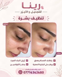✨ تنظيف البشرة في رينا للتجميل والليزر ✨ دلّلي بشرتچ وخليها تتنفس من ج...