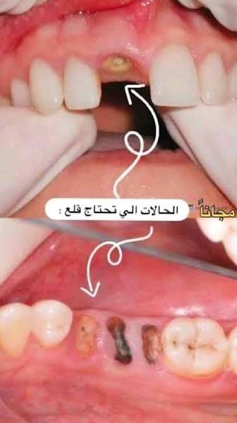 🦷🖤

يسرّني استقبالكم في عيادات الأسنان لتقديم خدمات طب وجراحة الفم والأسنان بأحدث التقنيات وبعناية متكاملة.

🔹 استقبل قلع الاسنان هكذا حالات كما موضح في الصور
🔹 حشوات مؤقتة ودائمية
🔹 طب أسنان الأطفال
بأشراف نخبة من الاطباء المختصين

👨‍⚕️ الدكتور علي عدنان رزيق 

📞 للحجز والاستفسار:*********** او مراسلة الصفحة 
📍 حلة – شارع 40، عيادات جامعة الحله مجاور صيدلية سلامتك
علما إن العلاج مجاني بلكامل
