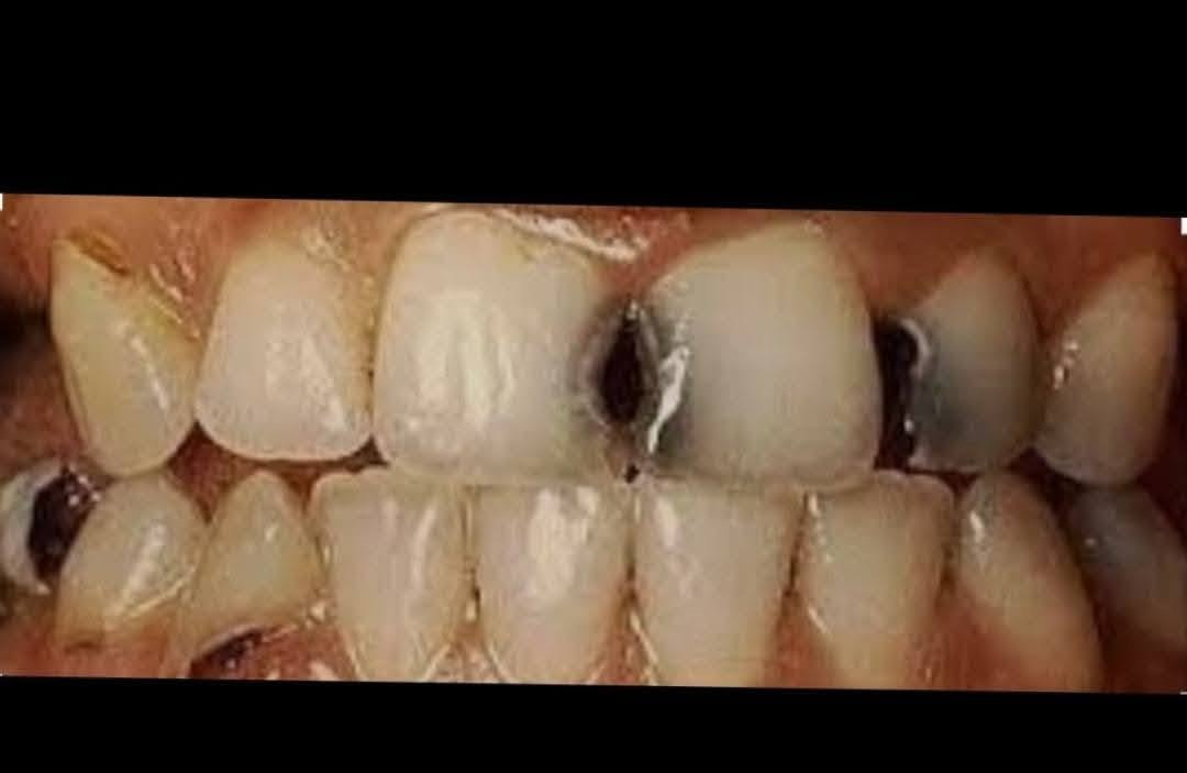 هلاو شباب اللي عدة هالحالات او احد من اهلة خلي يتواصل ويايه خاص للعلاج مجاناً
(تسوس او كسر الاسنان الامامية والخلفية ،قلع بقايا جذور او اسنان تالفة ، قلع سن العقل ، تنظييف الاسنان وازالة التكلسات٫ فحص اسنان الاطفال وعلاجها )
علماً ان الحشوات المستخدمة هي حشوات ضوئية بلون السن
العنوان شارع فلسطين 
***********

نص مكتوب في الصور:
- HONOR 400
- قبل....
- The image may have been resized.