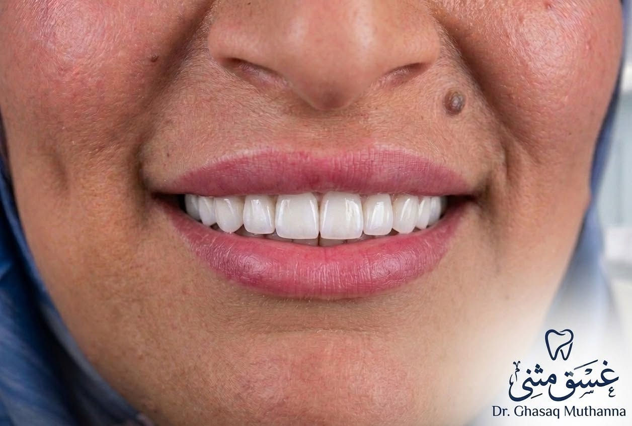 #عيادات النخبة تألق وتقدم دائم 💞
#عمل ابتسامة للاسنان الأمامية للفك #العلوي من مادة الزاركون الألماني #المريض كولش فرحان بشكله🥳 الجديد الف عافيه😍😍
مع فلر للشفايف😍☺️
# الحاله من من أعمال دكتورة
 غسق مثنى عاشت الايادي  👍😍
العمل أكثر من رائع 😁🥰👍🌺
العنوان
..الغزالية #-شارع المرور مقابل مول النمور-عمارة الرزان دوام العيادة من الساعه
(من 4عصرا الى9 مساءً)للحجز والاستفسار الاتصال على الرقم........(***********)
