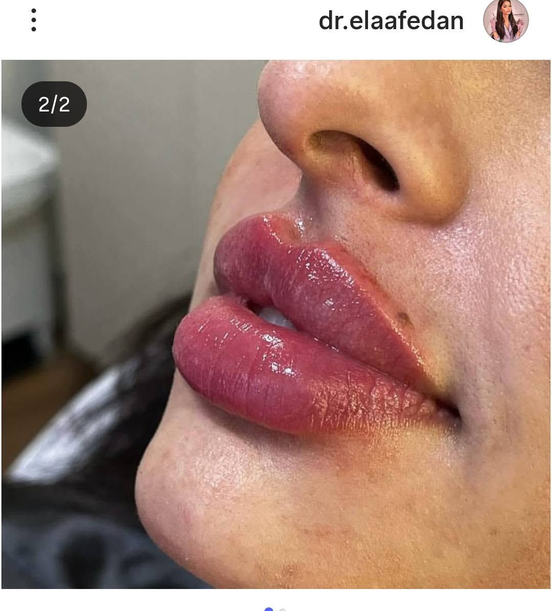 ✨ عيادة د. إيلاف للتجميل ✨
نقدم لكم خدمات تجميلية مميزة بأعلى مستوى من العناية والاهتمام 💉💖
📍 الموقع الأول:
مجمع الأفنان الطبي – مجاور عيادة د. إياد الزهيري
🗓 أيام الدوام:
الأربعاء | الخميس | الجمعة | السبت
📍 الموقع الثاني:
شارع مستشفى الصادق – مركز إن ستايل
🗓 باقي أيام الأسبوع:
متواجدين بالموقع الثاني لخدمتكم 🌸
📞 للحجز والاستفسار:
***********
✨ جمالكِ يبدأ من هنا… ثقة واهتمام بكل التفاصيل ✨
