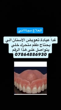تعويض سنان • طقم متحرك • العلاج ببلاش