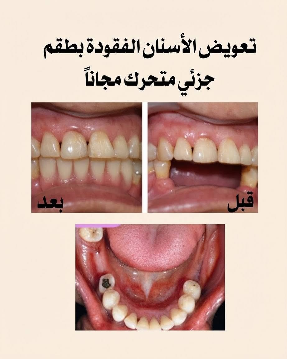 السلام عليكم
اني طالبة طب أسنان مرحلة رابعة
 
اشتغل عدة حالات مثل: 

• حشوات تجميلية 
• تنظيف أسنان وإزالة التكلسات والتصبغات
• قلع الأسنان والجذور المتبقية
• تعويض الأسنان بطقم جزئي متحرك

وأكيد العلاج مجاني وتحت إشراف أطباء أختصاص 

إذا عندك أي حالة من الحالات المذكورة بالبوست، صوّر الحالة ودز الصورة على الواتساب، حتى نقيم الحالة ونحدد موعد العيادة بإذن الله 🦷🥼

عنواني : جامعة الرافدين - بغداد - حي القاهرة - قرب الرعاية الأجتماعية 

رقم الواتساب: 
‎***********

نص مكتوب في الصور:
- رعاية كاملة لأسنانك جامعة الرافدين / بغداد / حي القاهرة دكتورة زهراء جاسم حشوات ضوئية "تجميلية" قلع الأسنان والجذور المتبقية تعويض الأسنان بطقم جزئي متحرك تنظيف الأسنان وإزالة التكلساك العلاج مجانا وتحت إشراف أطباء أختصاص للحجز وللاستفسار ارسل صورة للحالة على الواتساب *********** @dr.zahraa_j
- نستقبل حشوات ضوئية " تجميلية " مجاناً
- نستقبل تنظيف الأسنان وإزالة التكلسات والتصبغات مجاناً
- نستقبل قلع الأسنان والجذور المتبقية مجاناً
- تعويض الأسنان المفقودة بطقم جزئي متحرك مجاناً
- بعد
- قبل