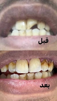 حالات اليوم مو اعادة بناء سن وإنما اعادة ابتسام ثقة وراحة للمريض
